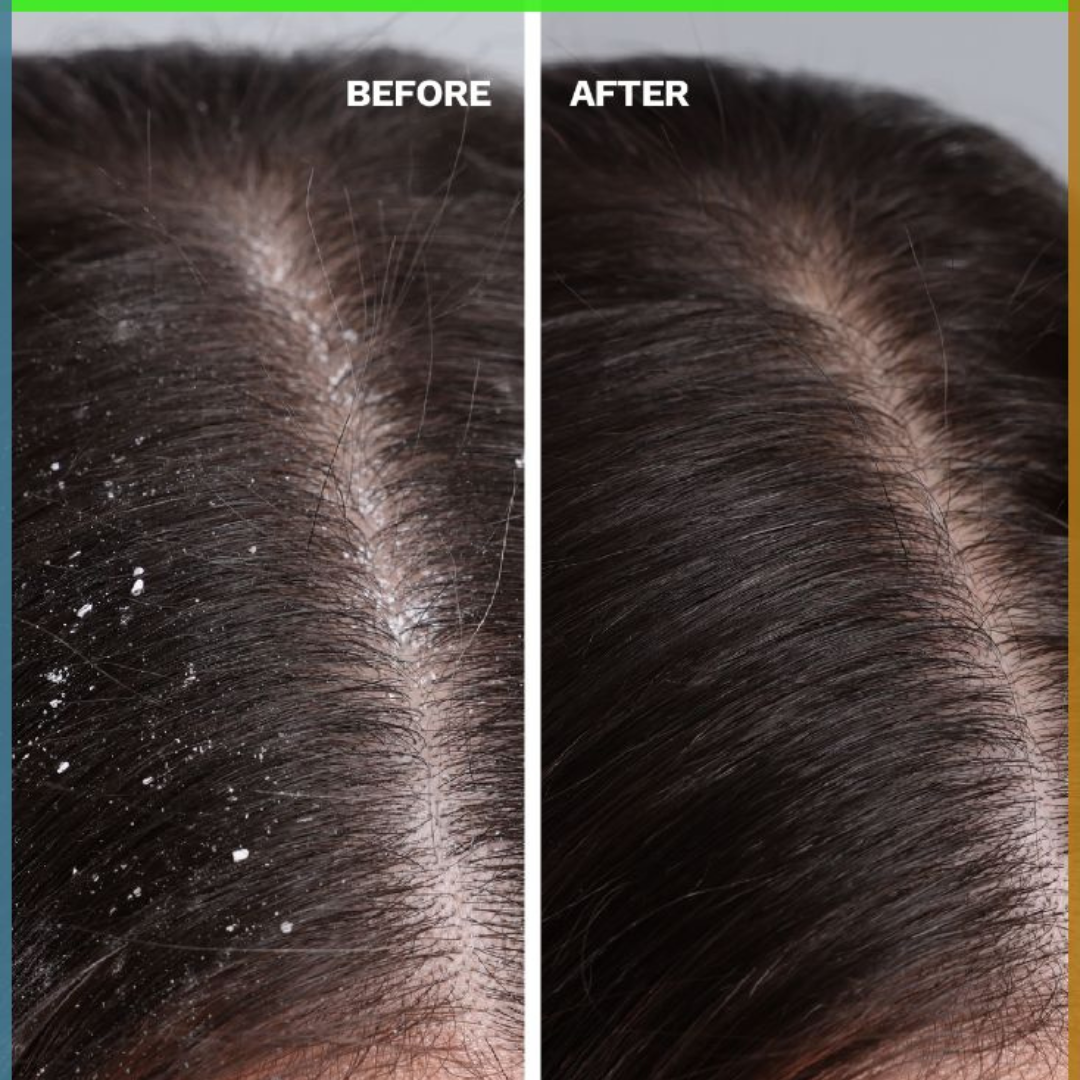 Anti Dandruff Treatment