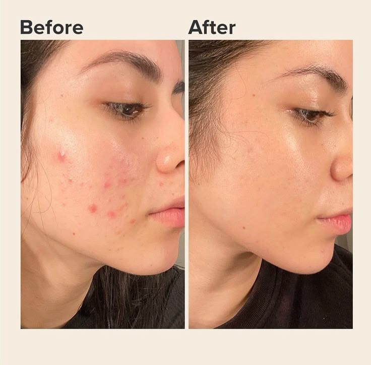 Acne Scars Treatment