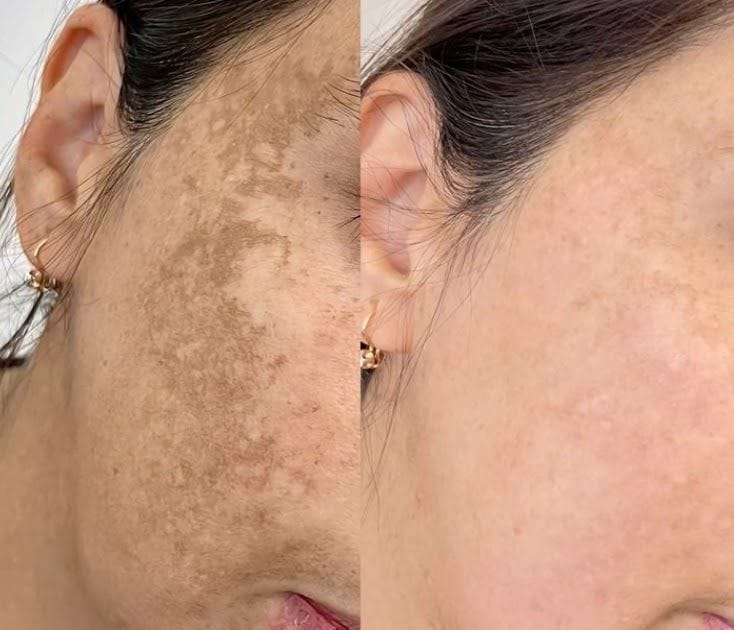 Pigmentation Treatment