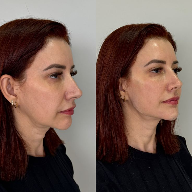 Skin Lifting Treatment